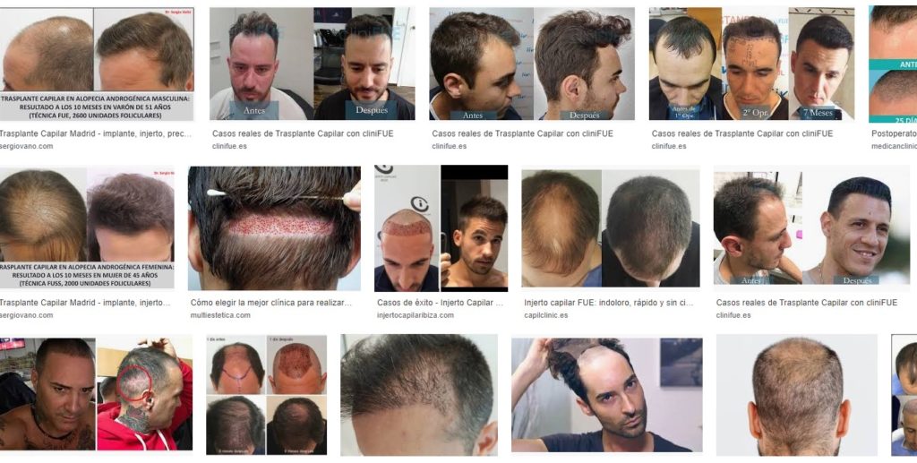 clinicas_injerto_capilar_madrid